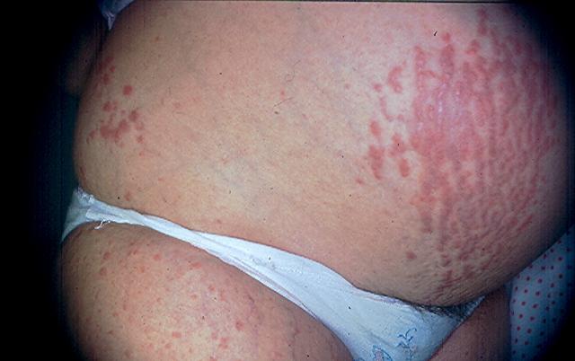 ΝΟΣΗΜΑΤΑ ΚΥΗΣΕΩΣ - Polymorphic Eruption of Pregnancy (Pruritic Urticarial Papules