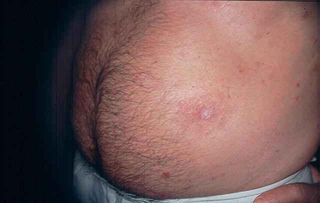 SKIN LESIONS IN HIV-AIDS PATIENTS - Malignant Syphilis