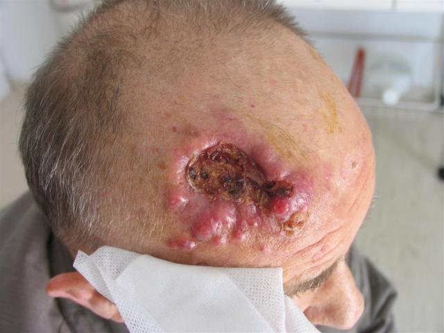 MALIGNANT LESIONS - Squamous Cell Carcinoma (SCC)