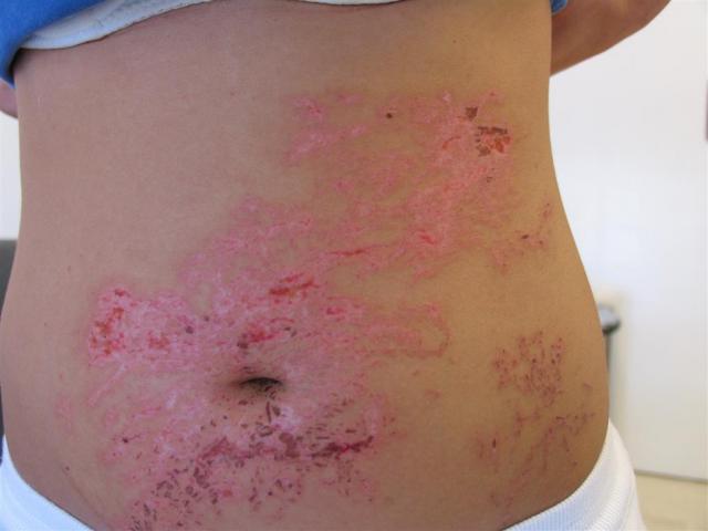 VARIOUS or of UNKNOWN ETIOLOGY DISEASES - Sea weed dermatitis