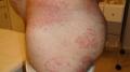 SUPERFICIAL FUNGAL INFECTIONS - Tinea Incognita