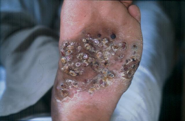 BACTERIAL INFECTIONS - Actinomycosis