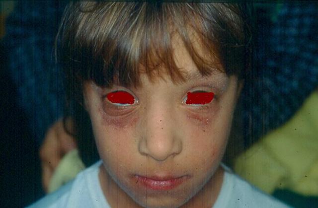 DERMATITIS - EKZEMA - Atopic dermatitis DERMATITIS - EKZEMA - Atopic dermatitis