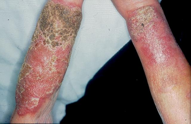 BACTERIAL INFECTIONS - Pyoderma vegetans