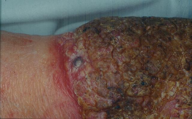 BACTERIAL INFECTIONS - Pyoderma vegetans BACTERIAL INFECTIONS - Pyoderma vegetans