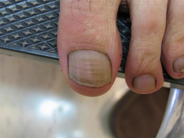 NAIL DISEASES - Nail staining