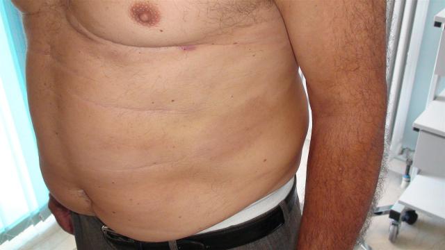 VARIOUS or of UNKNOWN ETIOLOGY DISEASES - Large-plaques Parapsoriasis VARIOUS or of UNKNOWN ETIOLOGY DISEASES - Large-plaques Parapsoriasis