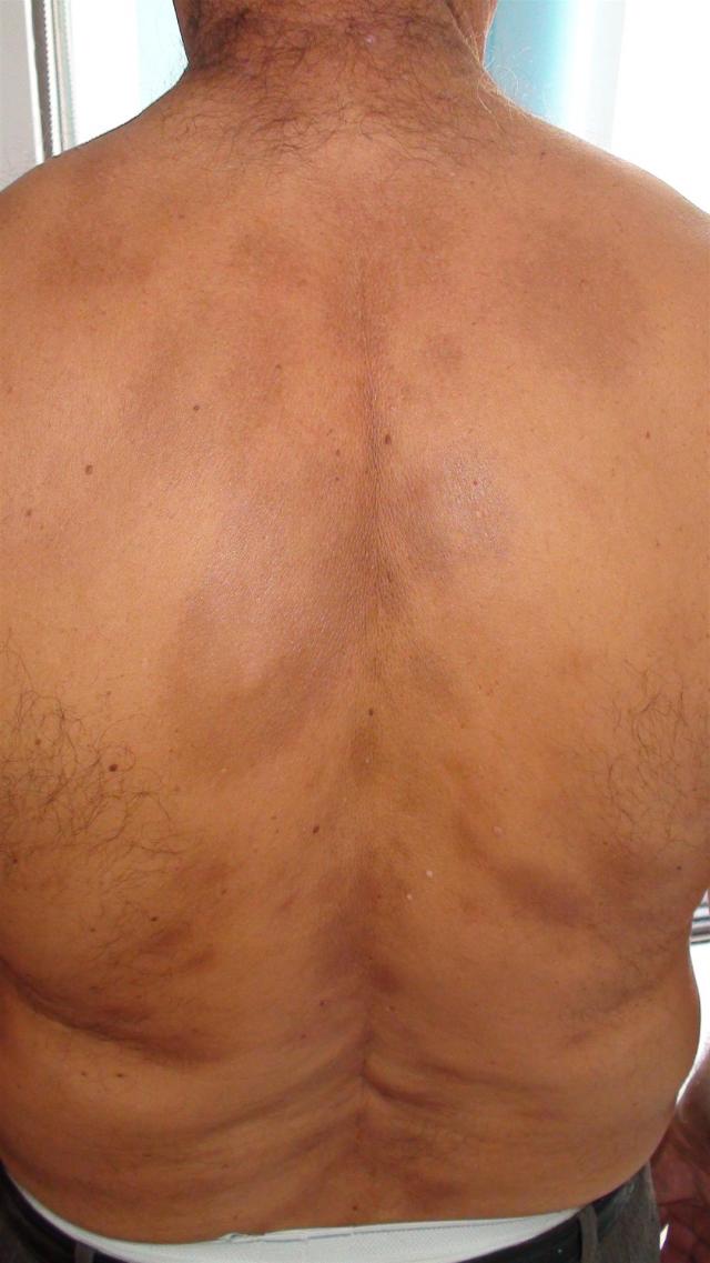 VARIOUS or of UNKNOWN ETIOLOGY DISEASES - Large-plaques Parapsoriasis VARIOUS or of UNKNOWN ETIOLOGY DISEASES - Large-plaques Parapsoriasis