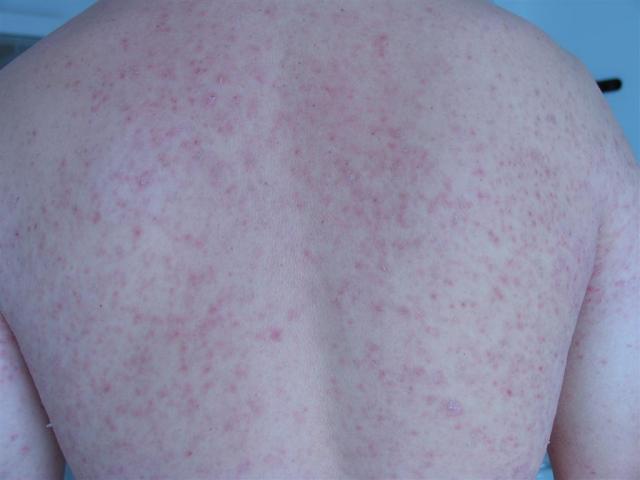 VARIOUS or of UNKNOWN ETIOLOGY DISEASES - Pityriasis lichenoides chronica