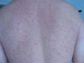 VARIOUS or of UNKNOWN ETIOLOGY DISEASES - Pityriasis lichenoides chronica