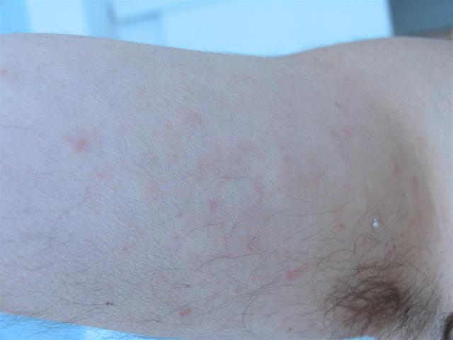 VARIOUS or of UNKNOWN ETIOLOGY DISEASES - Pityriasis lichenoides chronica VARIOUS or of UNKNOWN ETIOLOGY DISEASES - Pityriasis lichenoides chronica