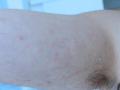 VARIOUS or of UNKNOWN ETIOLOGY DISEASES - Pityriasis lichenoides chronica