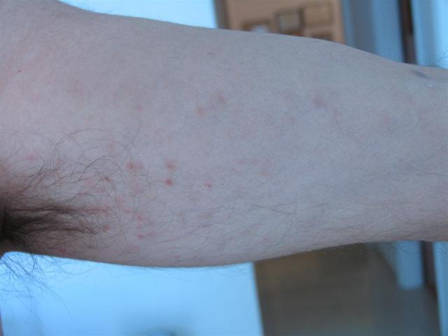 VARIOUS or of UNKNOWN ETIOLOGY DISEASES - Pityriasis lichenoides chronica