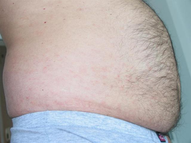 VARIOUS or of UNKNOWN ETIOLOGY DISEASES - Pityriasis lichenoides chronica VARIOUS or of UNKNOWN ETIOLOGY DISEASES - Pityriasis lichenoides chronica