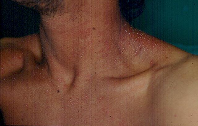 hiv lesions back