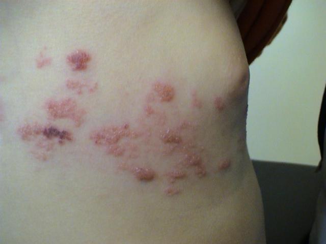 VIRAL INFECTIONS - Herpes Zoster VIRAL INFECTIONS - Herpes Zoster