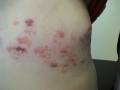 VIRAL INFECTIONS - Herpes Zoster