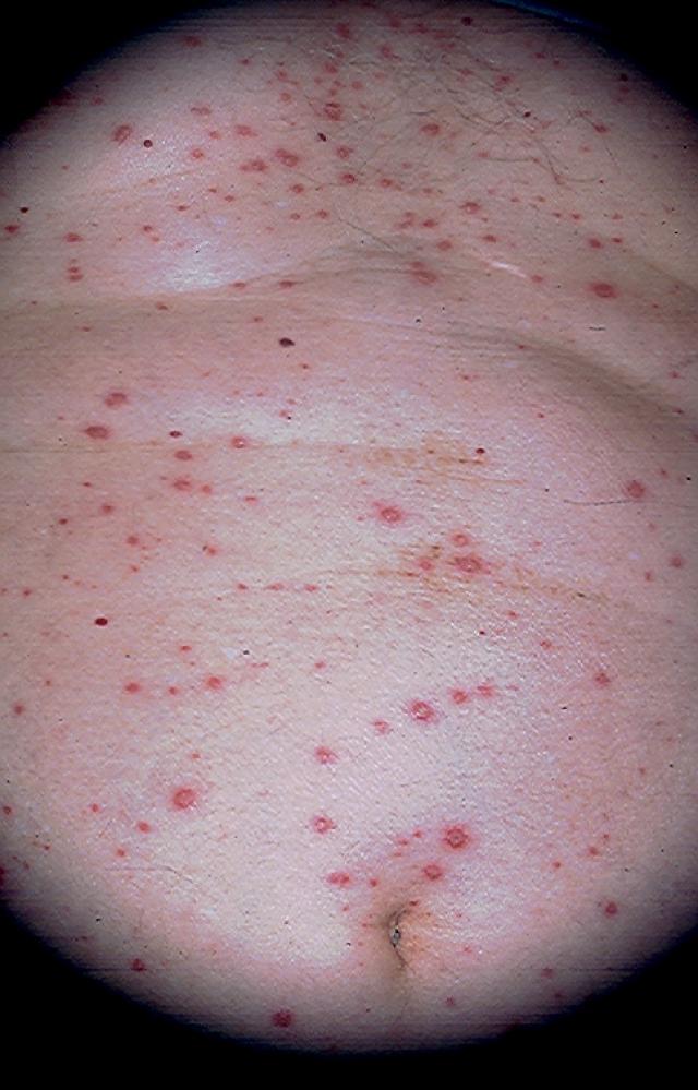 VIRAL INFECTIONS - Herpes Zoster VIRAL INFECTIONS - Herpes Zoster