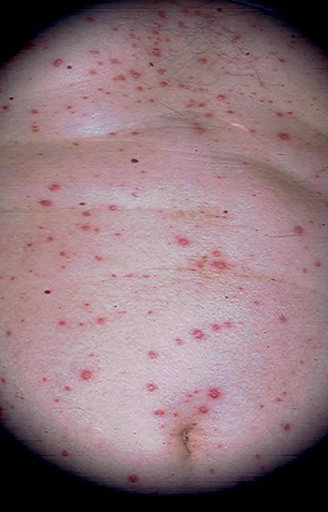 VIRAL INFECTIONS - Herpes Zoster