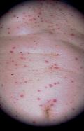 VIRAL INFECTIONS - Herpes Zoster