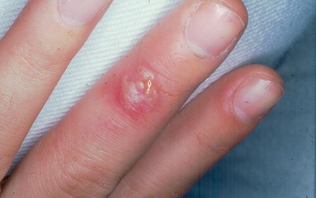 VIRAL INFECTIONS - Herpes Simplex VIRAL INFECTIONS - Herpes Simplex