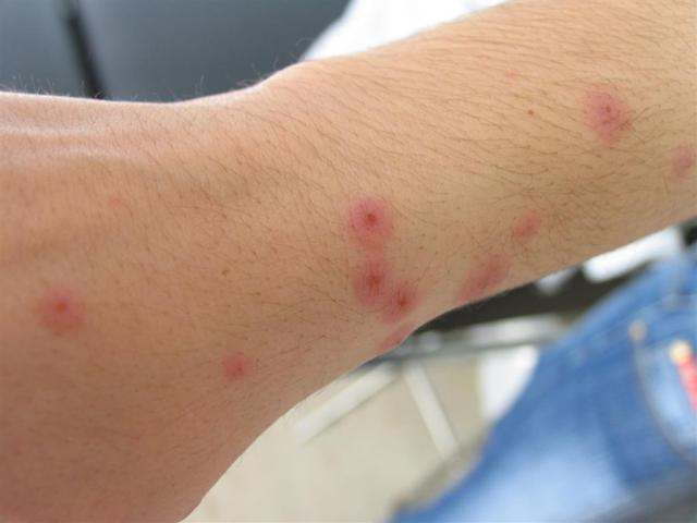 VARIOUS or of UNKNOWN ETIOLOGY DISEASES - Erythema Multiforme
