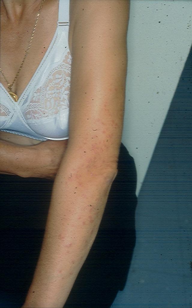 NECROBIOTIC DISORDERS - Granuloma annulare Generalised NECROBIOTIC DISORDERS - Granuloma annulare Generalised