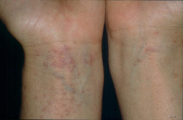 NECROBIOTIC DISORDERS - Granuloma annulare Generalised NECROBIOTIC DISORDERS - Granuloma annulare Generalised