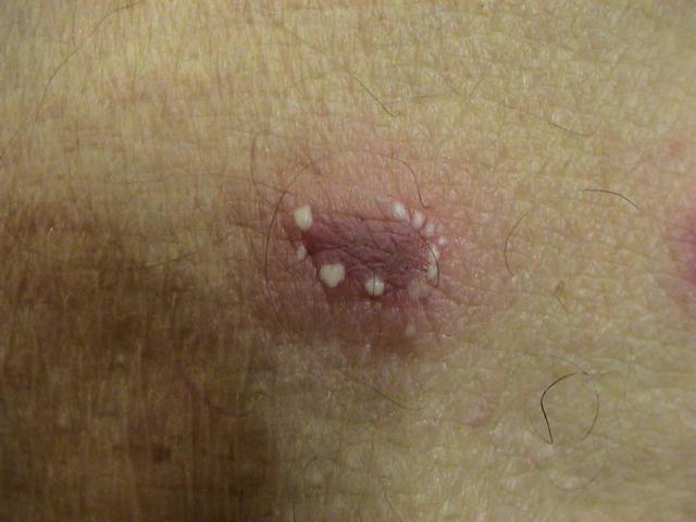 PSORIASIS - Pustular psoriasis PSORIASIS - Pustular psoriasis