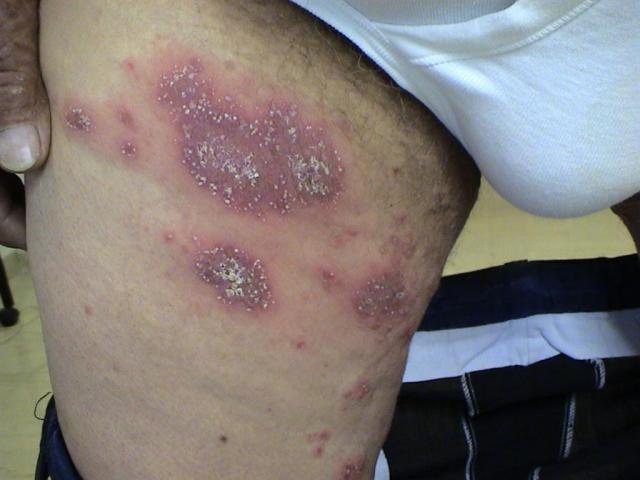 PSORIASIS - Pustular psoriasis