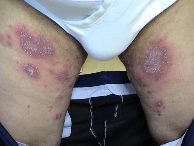 PSORIASIS - Pustular psoriasis