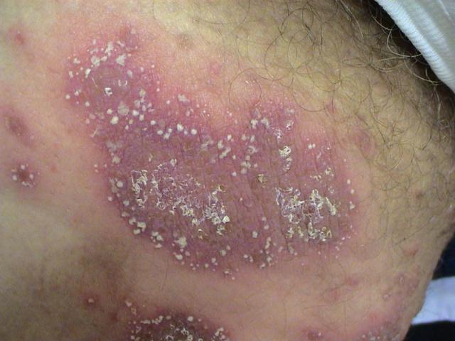 PSORIASIS - Pustular psoriasis PSORIASIS - Pustular psoriasis