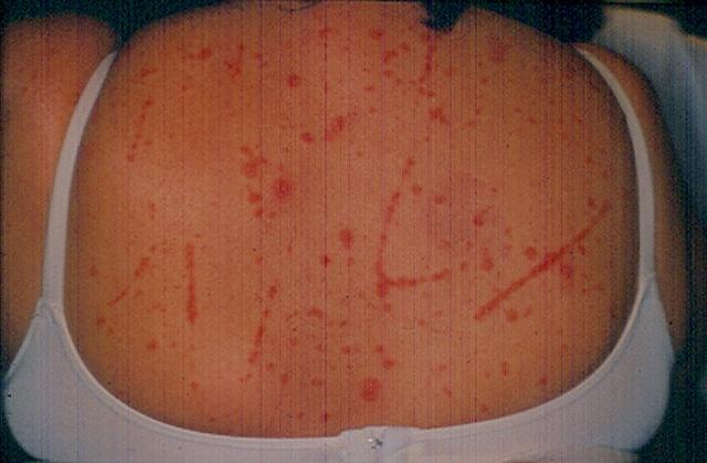 PSORIASIS - Psoriasis, Keobner phenomenon