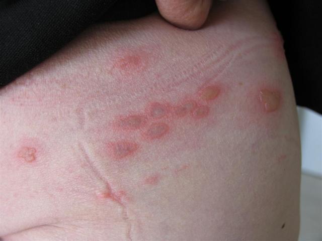 VIRAL INFECTIONS - Herpes Zoster VIRAL INFECTIONS - Herpes Zoster