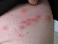 VIRAL INFECTIONS - Herpes Zoster