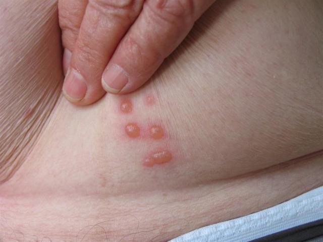 VIRAL INFECTIONS - Herpes Zoster VIRAL INFECTIONS - Herpes Zoster