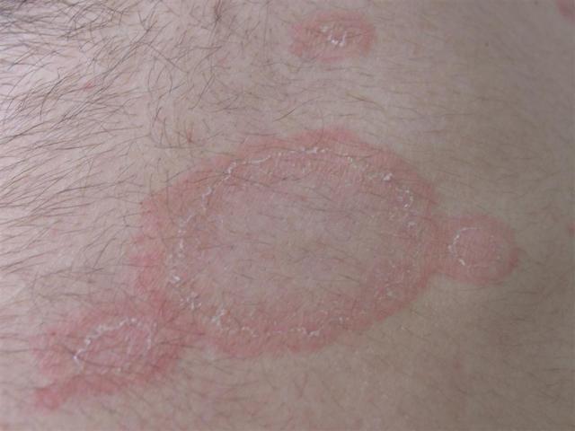VARIOUS or of UNKNOWN ETIOLOGY DISEASES - Pityriasis rosea VARIOUS or of UNKNOWN ETIOLOGY DISEASES - Pityriasis rosea