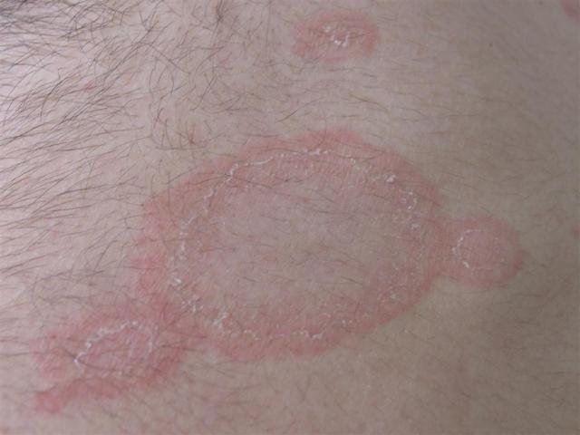 VARIOUS or of UNKNOWN ETIOLOGY DISEASES - Pityriasis rosea