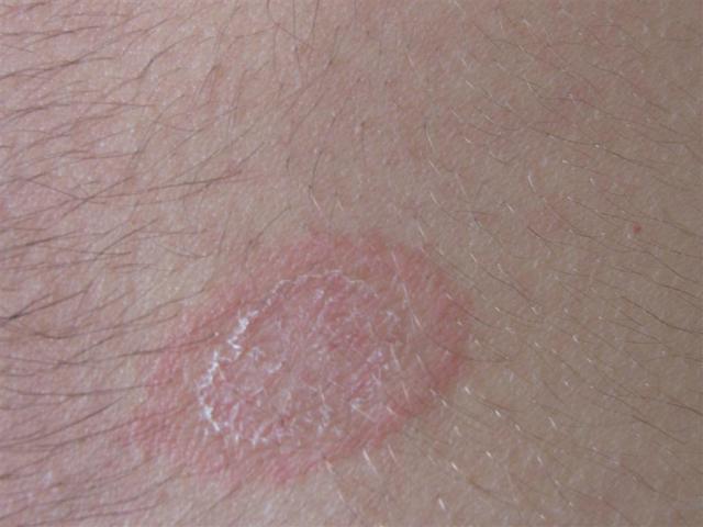 VARIOUS or of UNKNOWN ETIOLOGY DISEASES - Pityriasis rosea