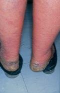 KERATINISATION DISORDERS - Pityriasis rubra pilaris