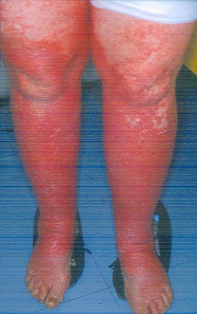 KERATINISATION DISORDERS - Pityriasis rubra pilaris