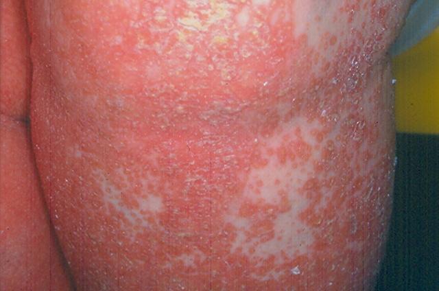 KERATINISATION DISORDERS - Pityriasis rubra pilaris