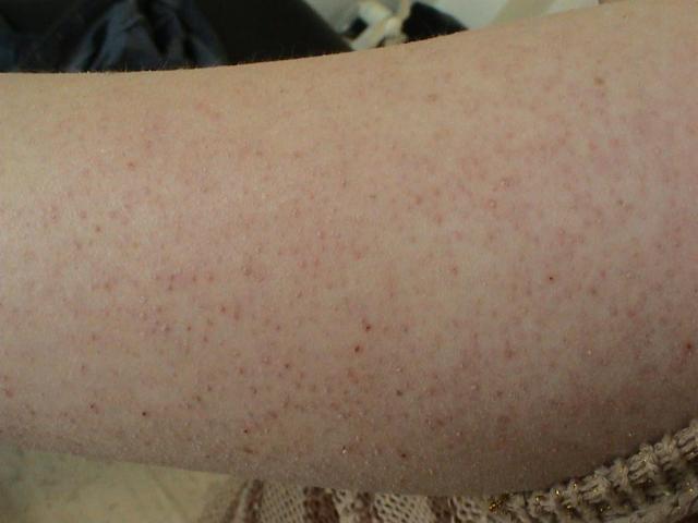 KERATINISATION DISORDERS - Darier disease KERATINISATION DISORDERS - Darier disease