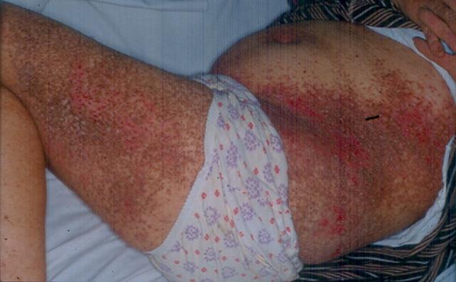 KERATINISATION DISORDERS - Darier disease KERATINISATION DISORDERS - Darier disease