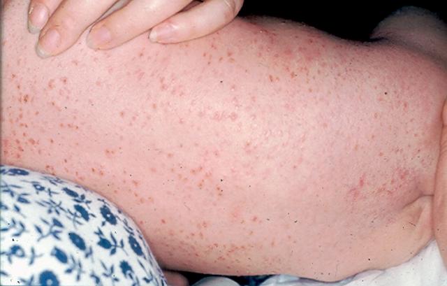 MASTOCYTOSES - Langerhans Cell Histiocytosis MASTOCYTOSES - Langerhans Cell Histiocytosis