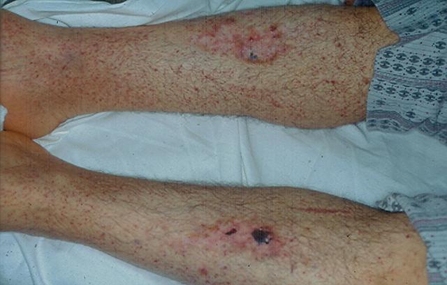 SKIN LESIONS IN SYSTEMIC DISEASES - Thrombocytopenic purpura (lesions of the mucosa)