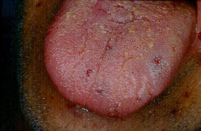 SKIN LESIONS IN SYSTEMIC DISEASES - Thrombocytopenic purpura (lesions of the mucosa)