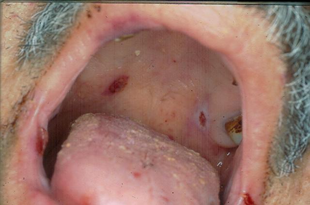 SKIN LESIONS IN SYSTEMIC DISEASES - Thrombocytopenic purpura (lesions of the mucosa)