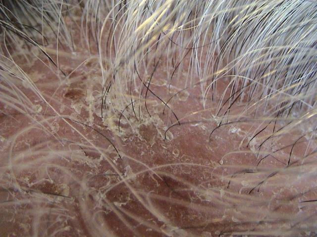 diseases of the scalp