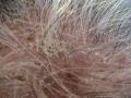 HAIR DISEASES - Follicular Lichen Planus (Lichen Planopilaris)